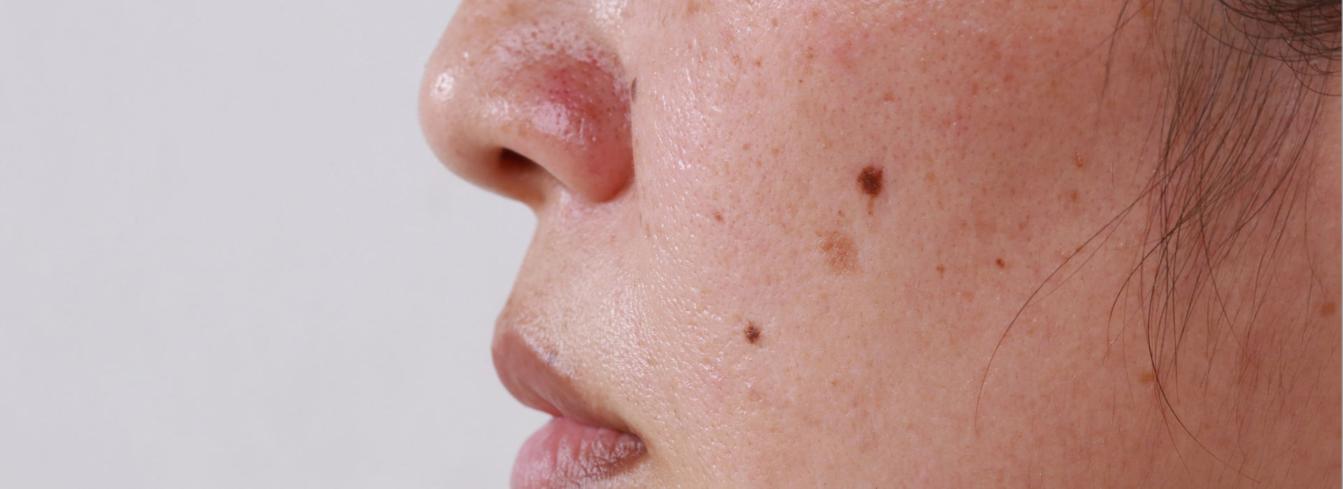 A woman is having brown spots on the skin.