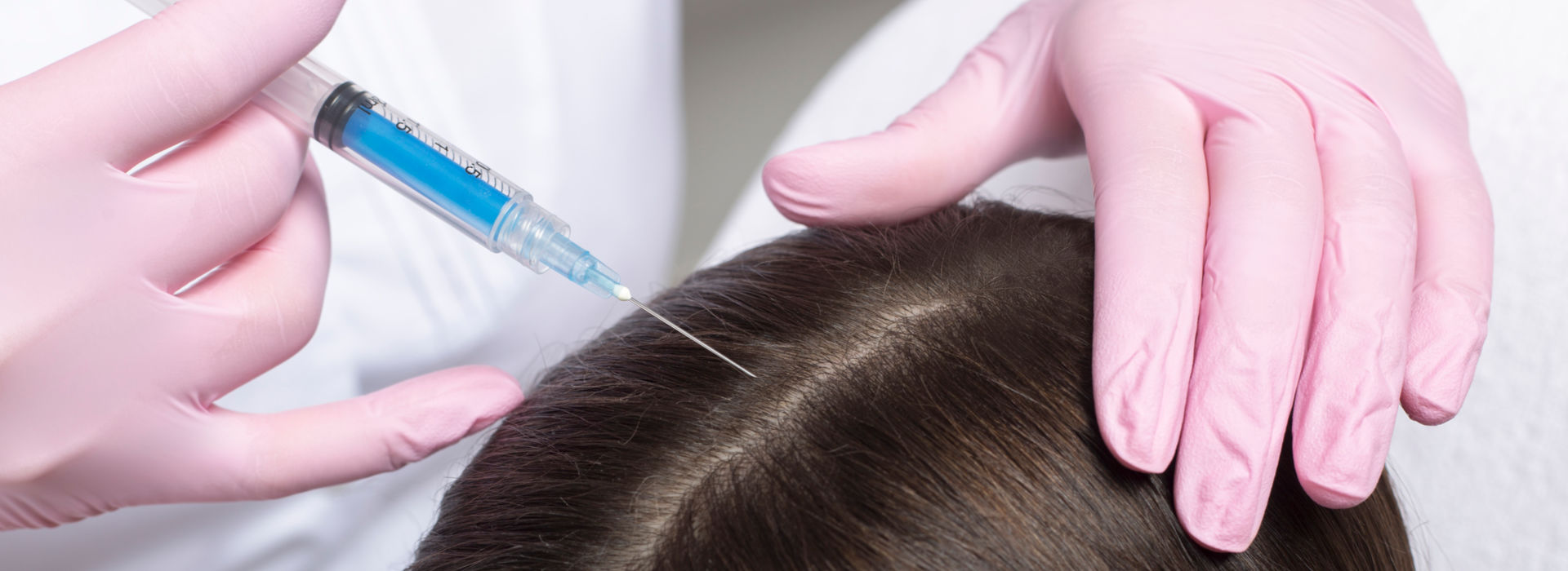 A woman is having a platelet-rich fibrin matrix (prfm) injections for hair thinning.