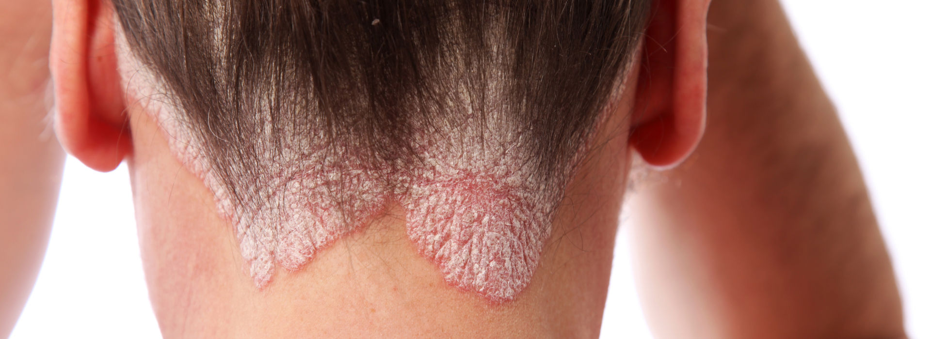 Woman with psoriasis.