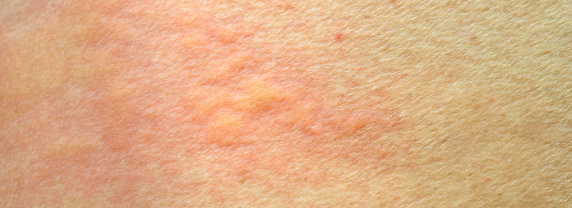 Skin rash